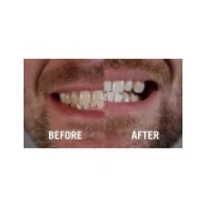 Gel Albire Dinti, Dr. George, Dental White, Mulaje si Aplicator Incluse, Concentratie 16%, 148gr