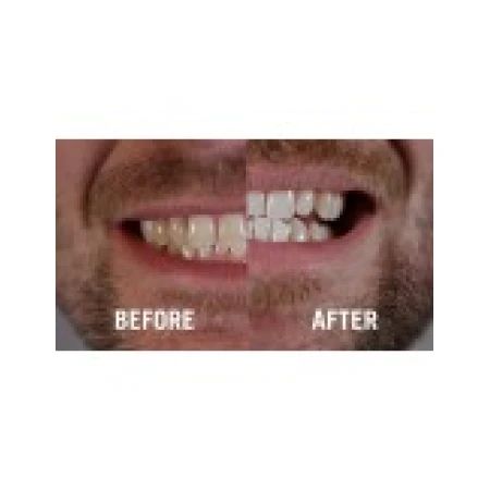 Gel Albire Dinti, Dr. George, Dental White, Mulaje si Aplicator Incluse, Concentratie 16%, 148gr