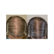 Solutie 3 Luni, Rogaine, Minoxidil 2%, Tratament Impotriva Caderii Parului, pentru Femei, 3x 60ml