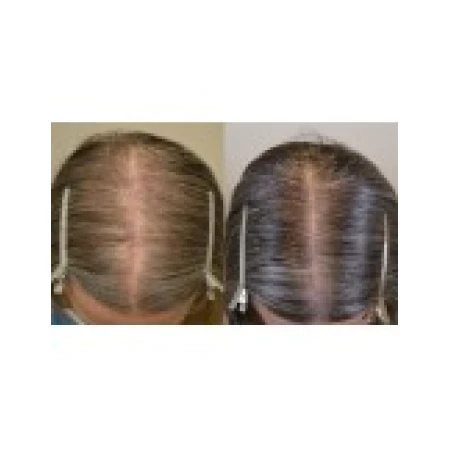 Solutie 3 Luni, Rogaine, Minoxidil 2%, Tratament Impotriva Caderii Parului, pentru Femei, 3x 60ml