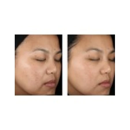 Gel Anti-Rid, Menarini, Anti-Acnee, Tretinoin 0.025%, 20gr