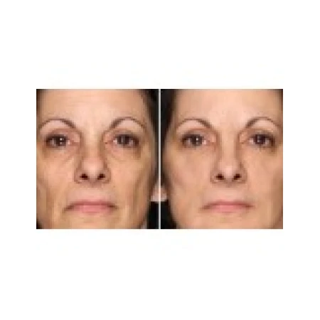 Gel Anti-Rid, Menarini, Anti-Acnee, Tretinoin 0.025%, 20gr