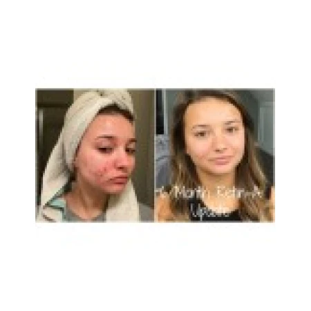 Gel Anti-Rid, Menarini, Anti-Acnee, Tretinoin 0.025%, 20gr