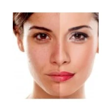 Crema, Abbott, Melalite Forte, Tratament Melasma prin Depigmentare Piele, Hidrochinona 4%, 30gr
