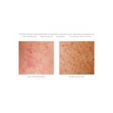 Gel de Dus, Glytone, Exfoliating Body Wash, 8.8% Acid Glicolic, Keratosis Pilaris, Exfoliaza si Netezeste Pielea, 200ml