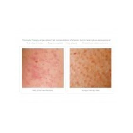 Gel de Dus, Glytone, Exfoliating Body Wash, 8.8% Acid Glicolic, Keratosis Pilaris, Exfoliaza si Netezeste Pielea, 200ml