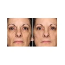 Gel Anti-Rid, Menarini, Anti-Acnee, Tretinoin 0.05%, 20gr