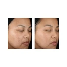 Gel Anti-Rid, Menarini, Anti-Acnee, Tretinoin 0.05%, 20gr