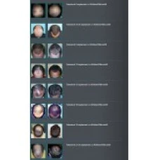 Solutie 9 Luni, Kirkland, Minoxidil, 5%, Tratament Impotriva Caderii Parului, 9x 60ml