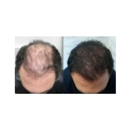 Solutie 1 Luna, Cipla, Tugain, Minoxidil, 10%, Tratament Impotriva Caderii Parului, Pipeta, Spray, 1x 60ml