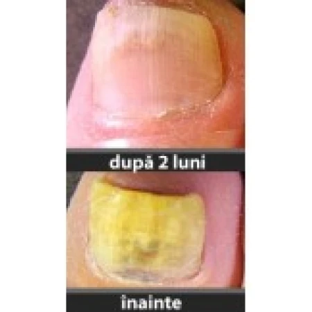 Tratament Unghii, Fungi-Nail, Kramer Healthcare, Impotriva Ciupercii din Jurul Unghiei, 4 luni, 2x 30ml