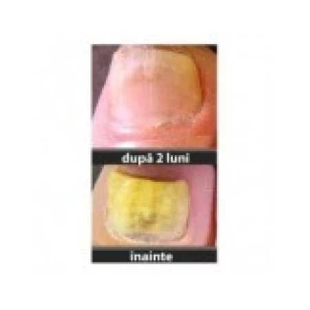 Tratament Unghii, Fungi-Nail, Kramer Healthcare, Impotriva Ciupercii din Jurul Unghiei, 4 luni, 2x 30ml